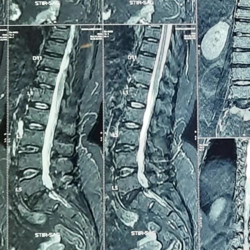 Lumbar Slip Disc with Weak Disc 1 - best spine Surgeon doctor in jaipur -B