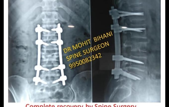 Spine Surgery for TB of Spine 2-A